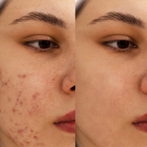 Acne Facial Treatment in Brampton