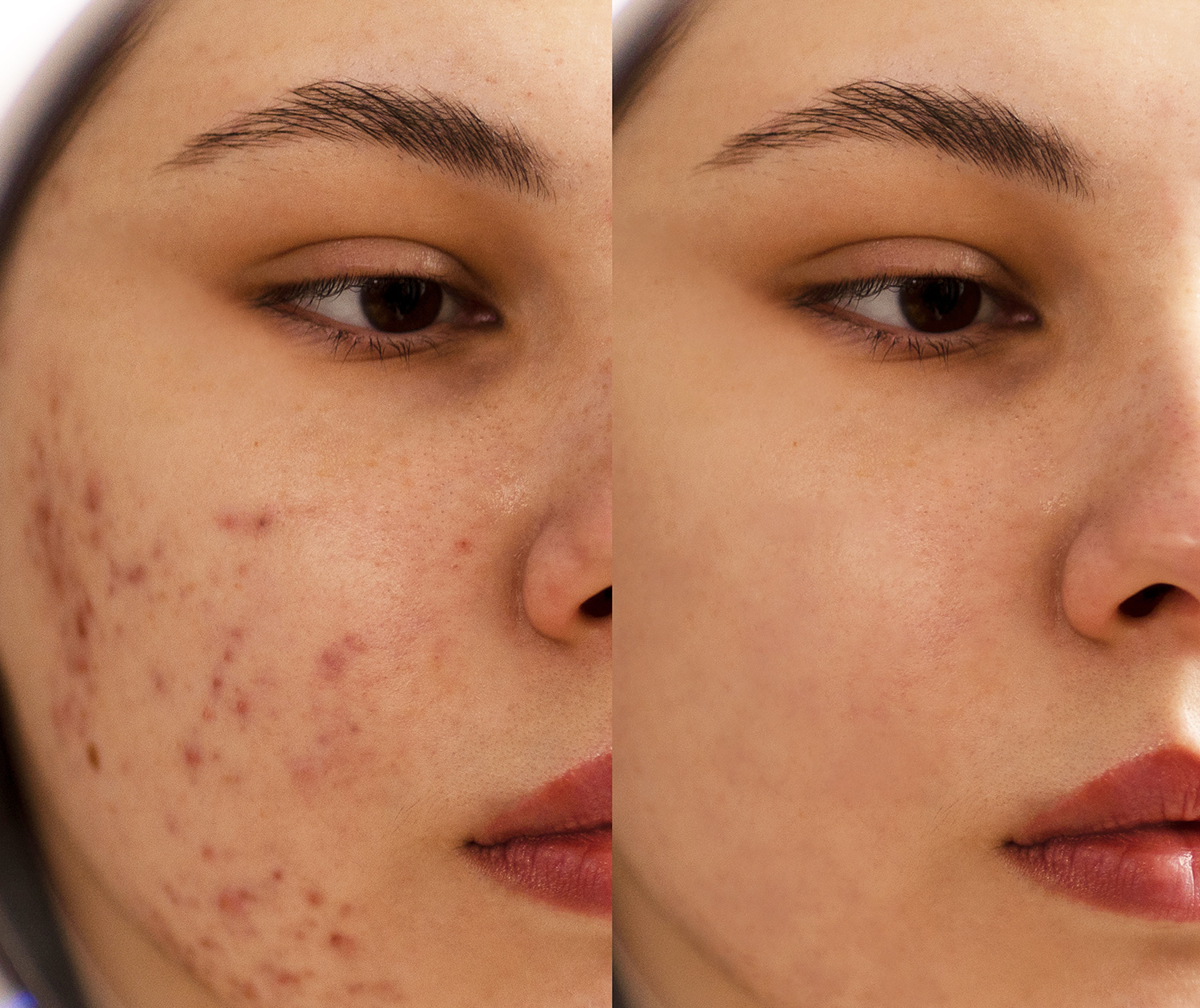 Acne Facial Treatment in Brampton